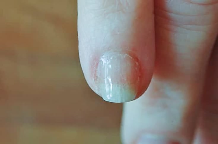 Nail polish on mended fingernail.