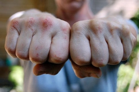 Close up shot of hands clenched into fists, knuckles bleeding with abrasions.