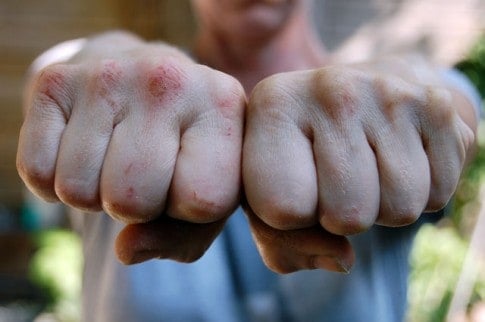 Close up shot of hands clenched into fists, knuckles bleeding with abrasions. 