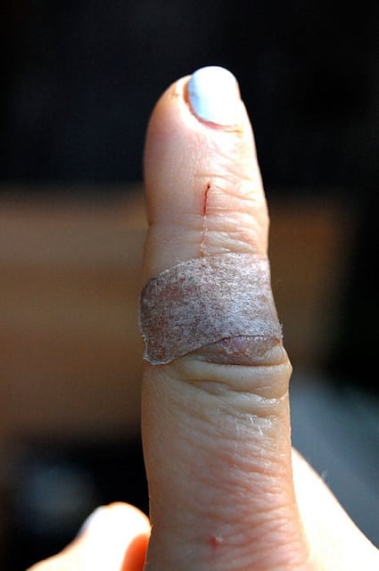 Coop Injury Finger
