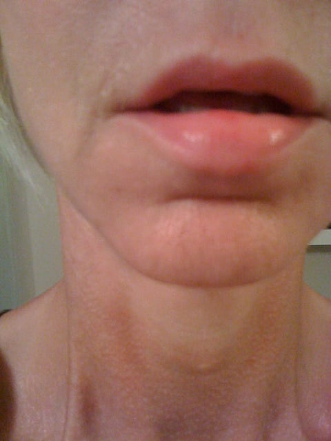 coop injury lip