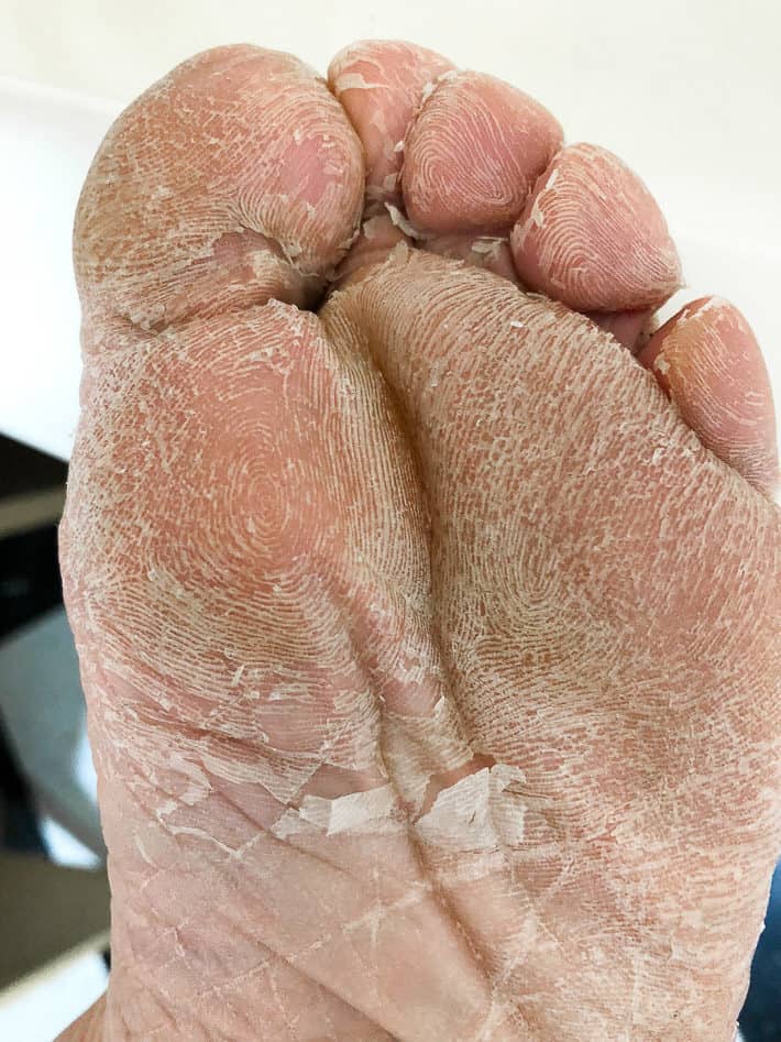 scaly foot skin