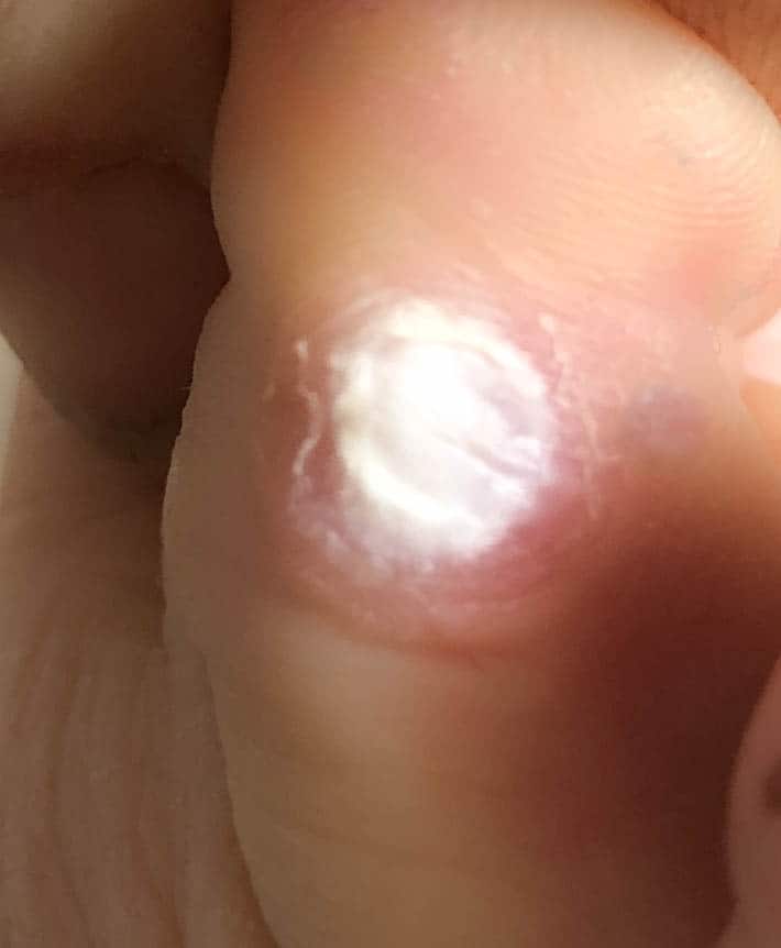 dr scholl's plantar wart pads