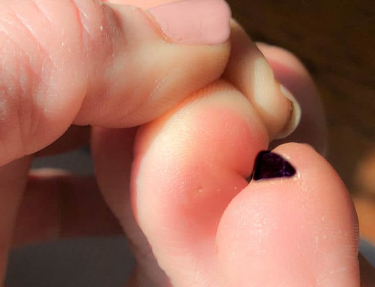 Plantar's warts usually appear on the sole of the foot, but in some cases will show up in between toes like this.