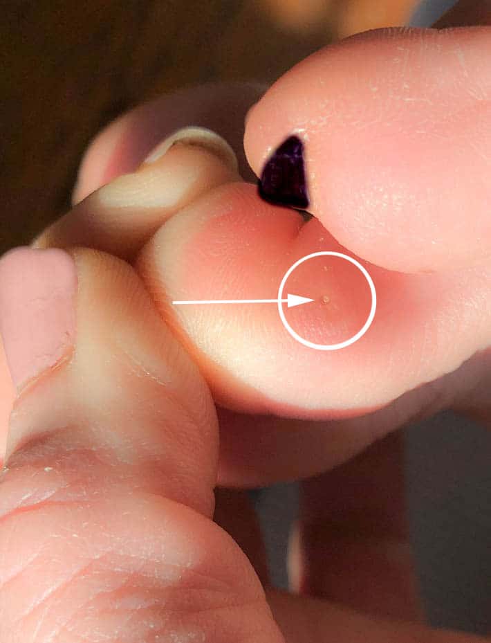 The telltale sign of a plantar wart is the small indented circle with a black pinhead point in the centre. It's all surrounded by a thick callous that builds up over time.