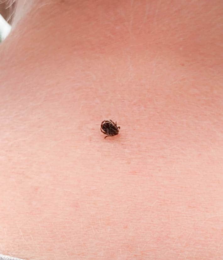 A male dog tick with its mouth parts embedded in the back of a woman's neck prior to removing it.