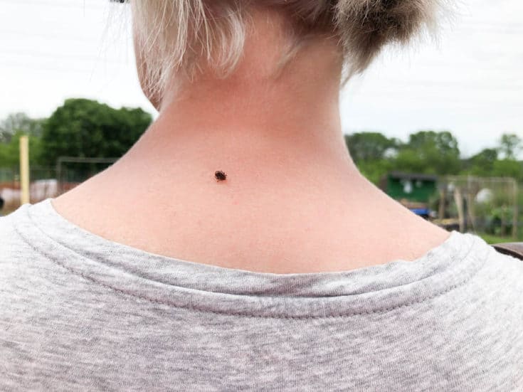 A dog tick attached to the back of a woman's neck while outside in a garden.