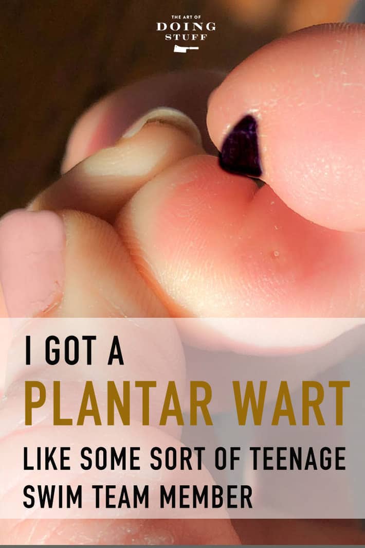 Pulling Out a Plantar Wart Root (eek)