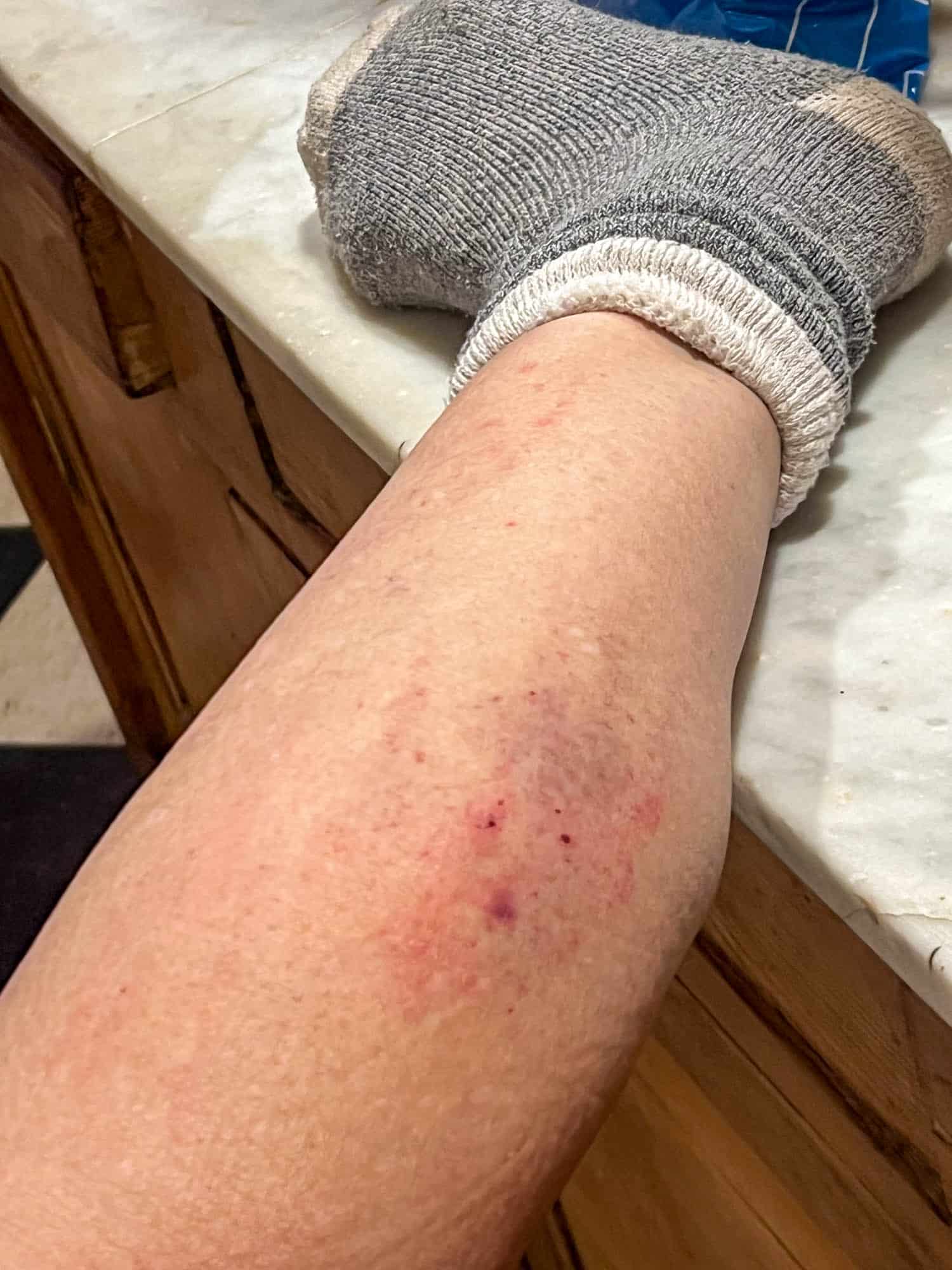 A foot rests on a countertop showing the bruised calf and bug bites.